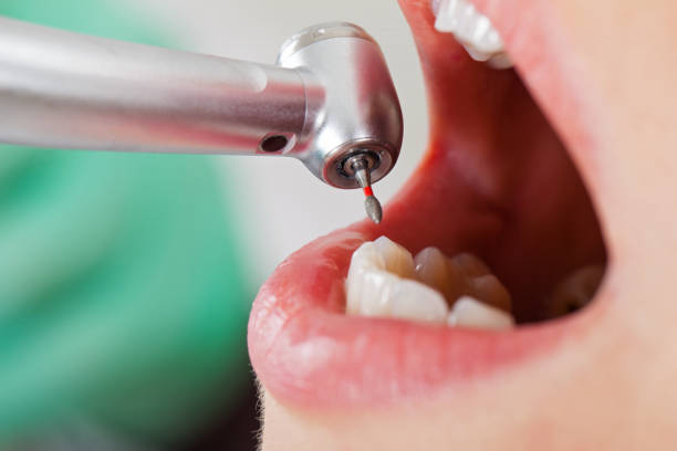 Best Knocked-Out Tooth (Avulsed Tooth) Treatment in Dixmoor, IL
